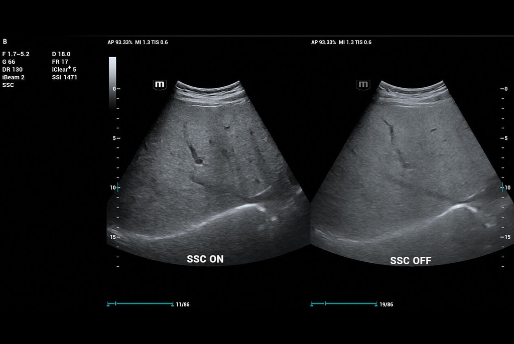 SSC(Sound Speed Compensation), Focus Free, HD Scope