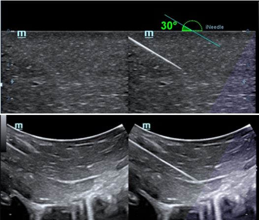 iNeedle™ - Софтуер за ехограф Mindray