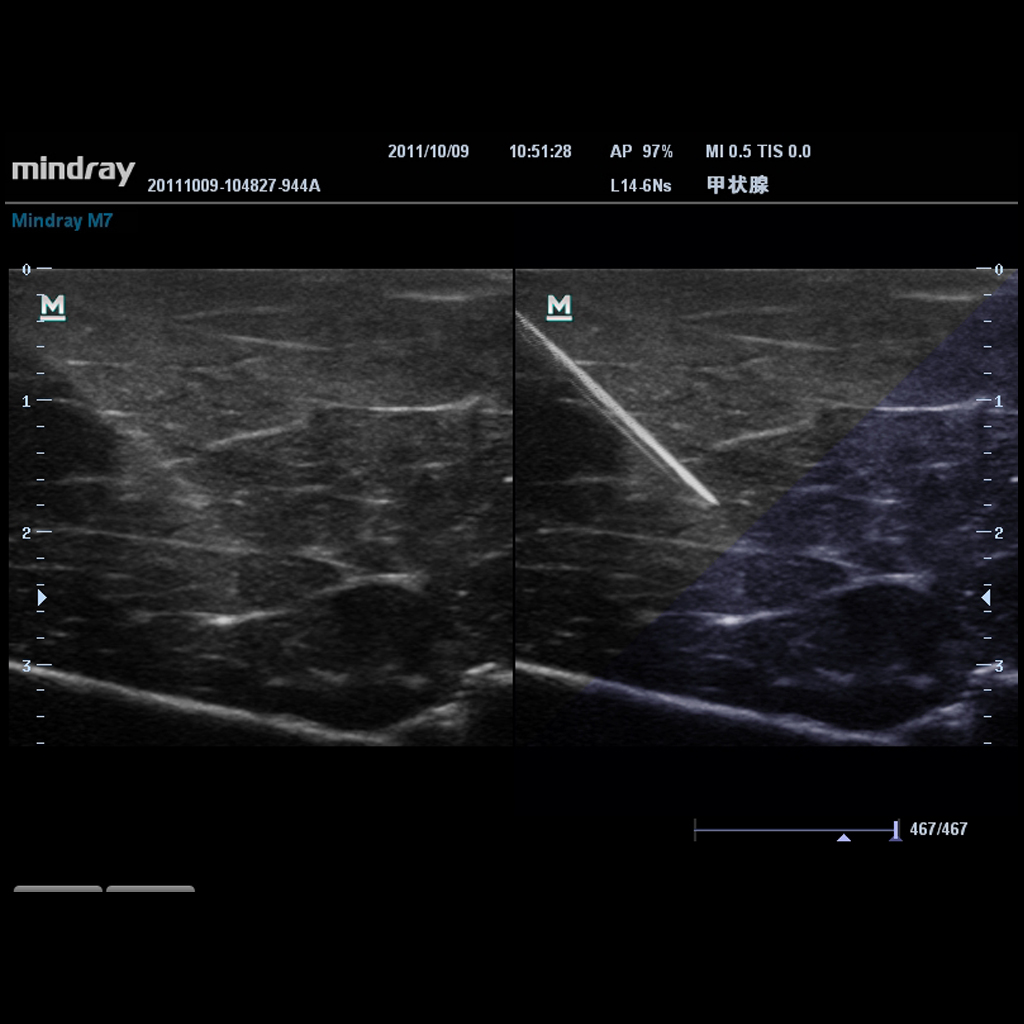 iNeedle™ - Mindray Ultrasound Software