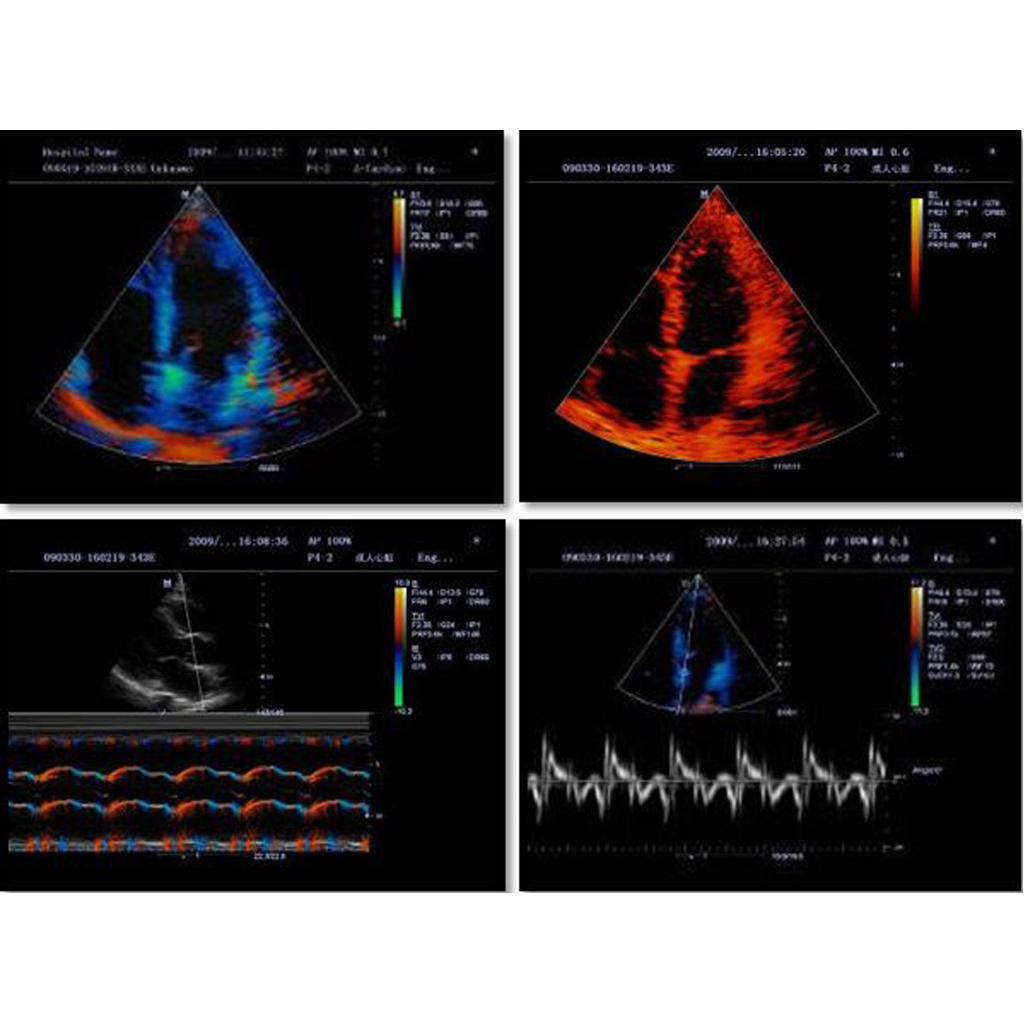 TDI (Tissue Doppler Imaging, includes TVI, TEI, TVD and TVM) - Mindray Ultrasound Software