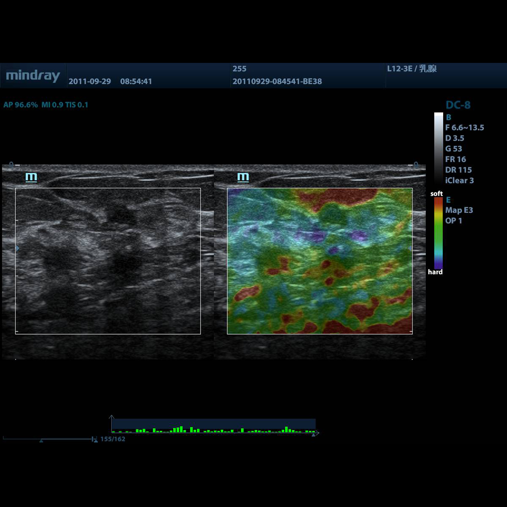 Natural Touch Elastography - Mindray ultrasound software