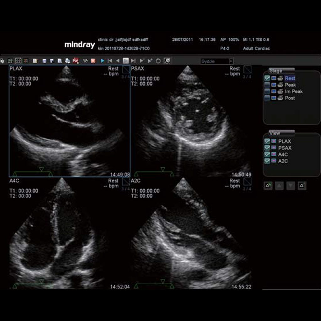 Stress Echo - Софтуер за ехограф Mindray