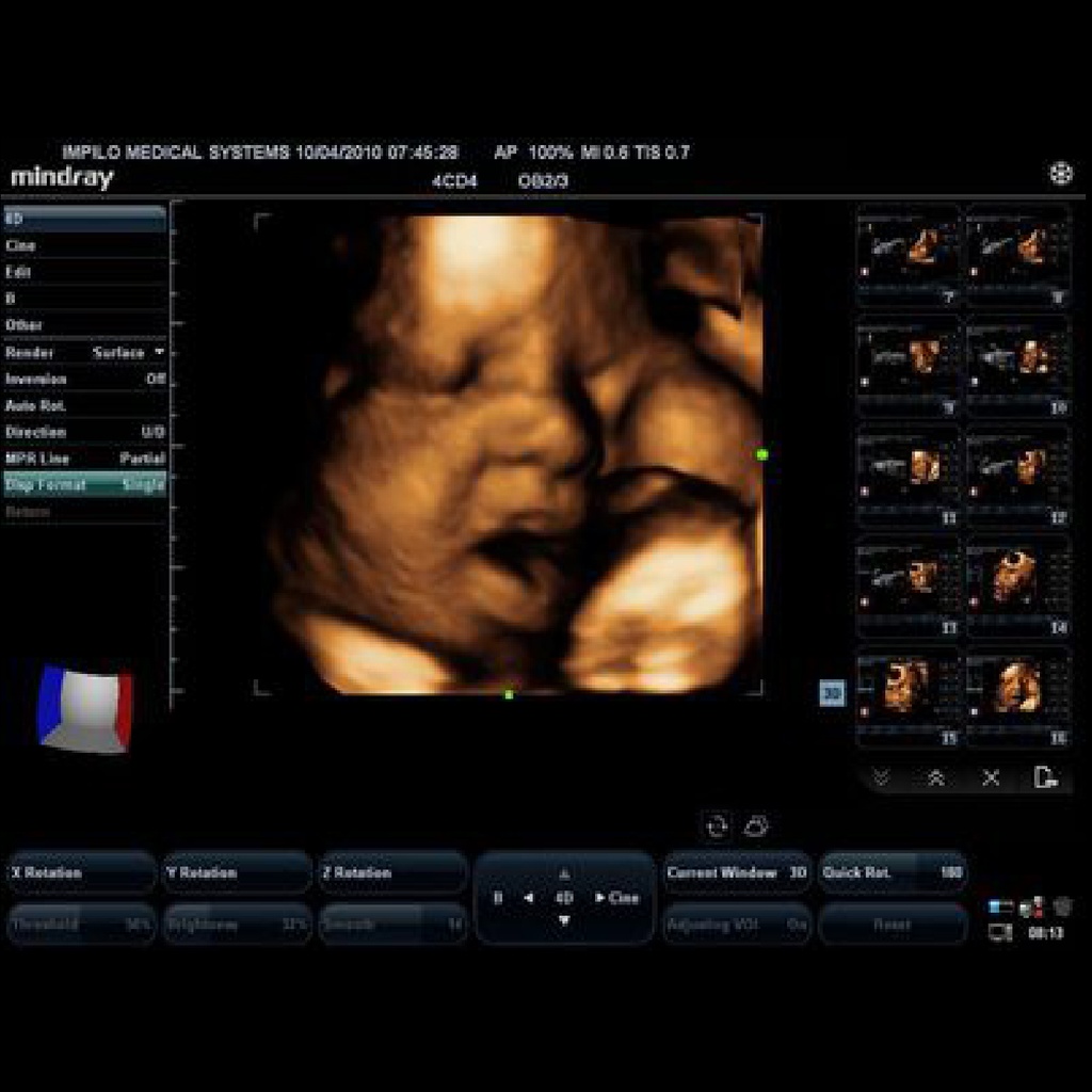 Smart 3D™ (freehand 3D) - Mindray ultrasound software