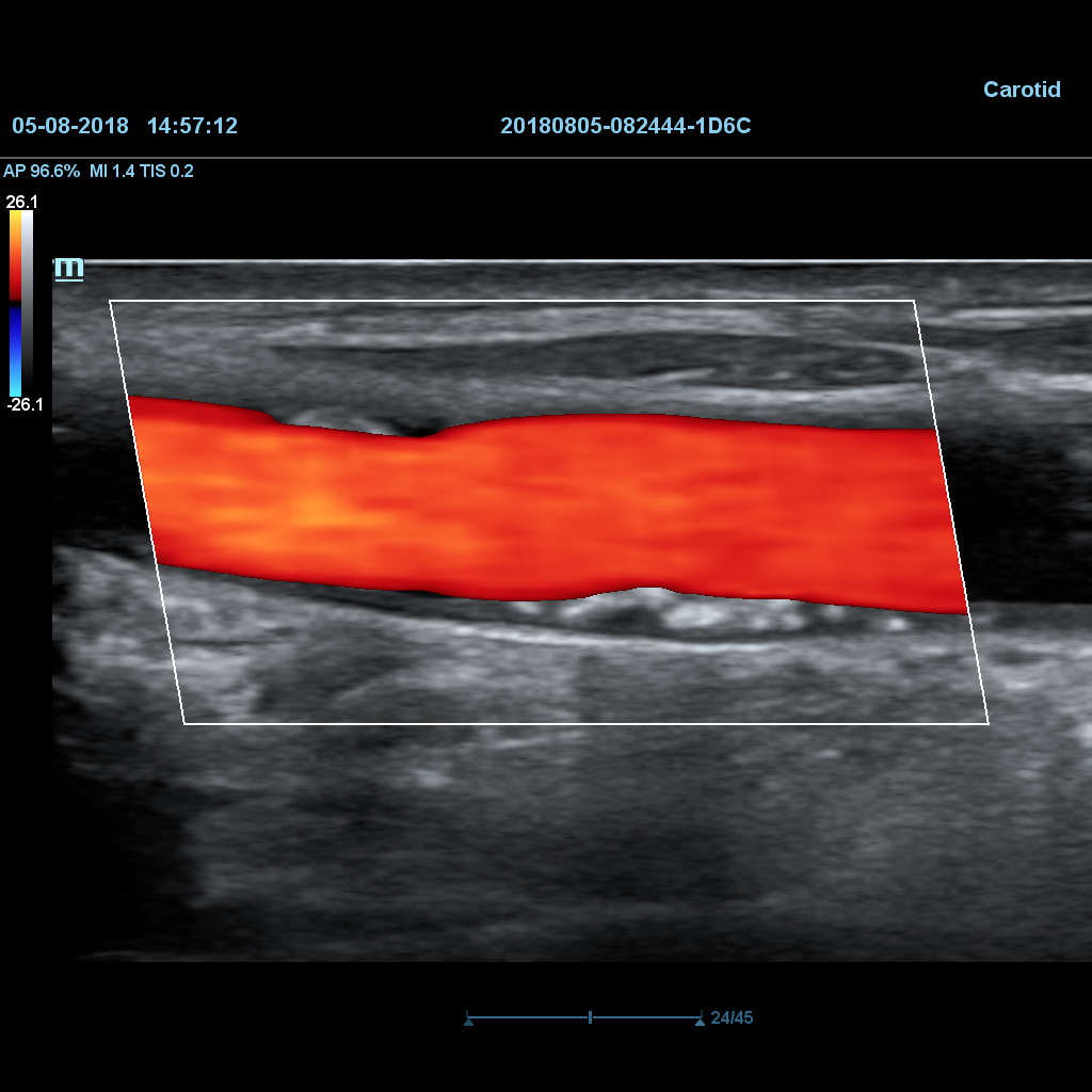 iWorks™ (Standardized Workflow Protocol) - Mindray Ultrasound Software