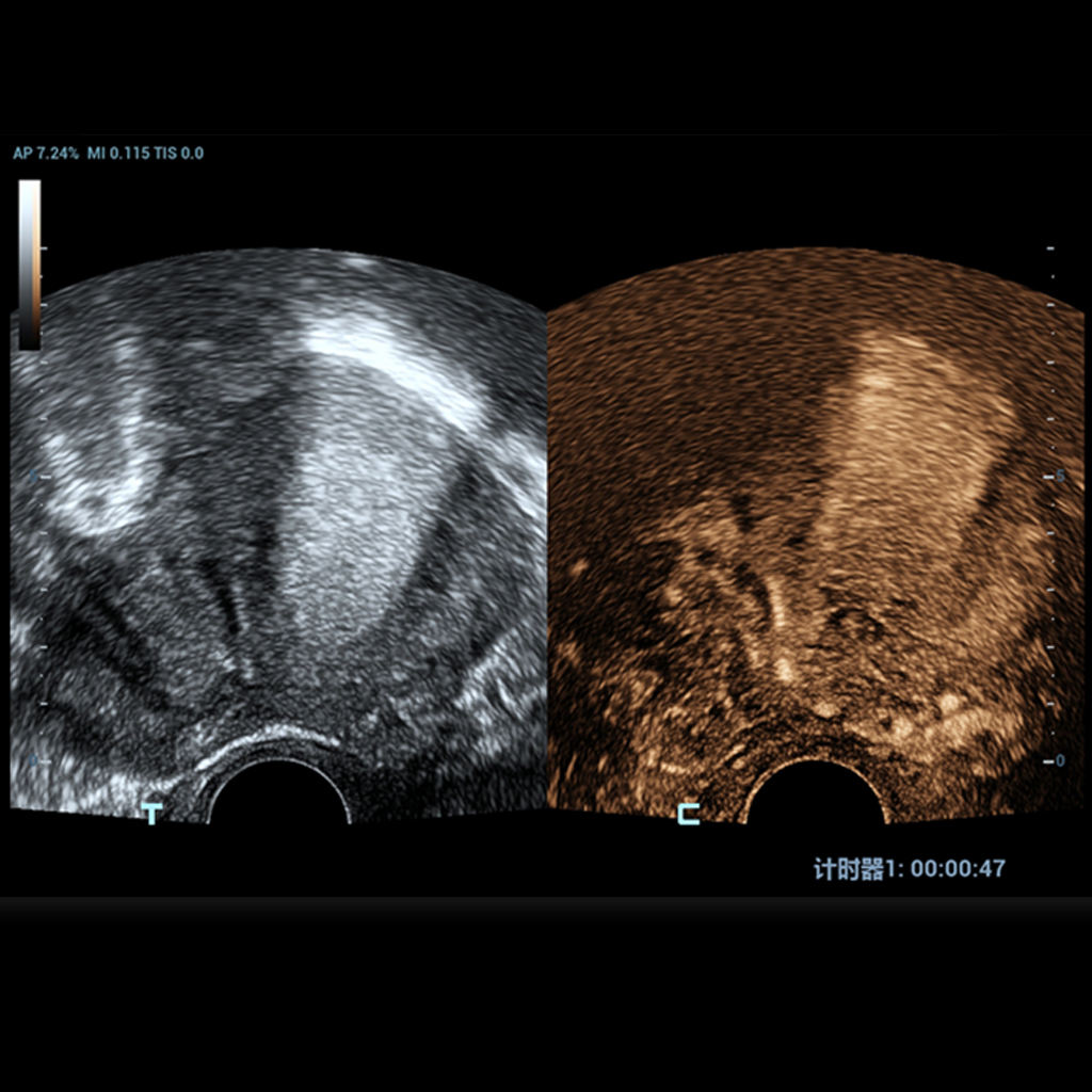 UWN Contrast Imaging™ - Софтуер за ехограф Mindray