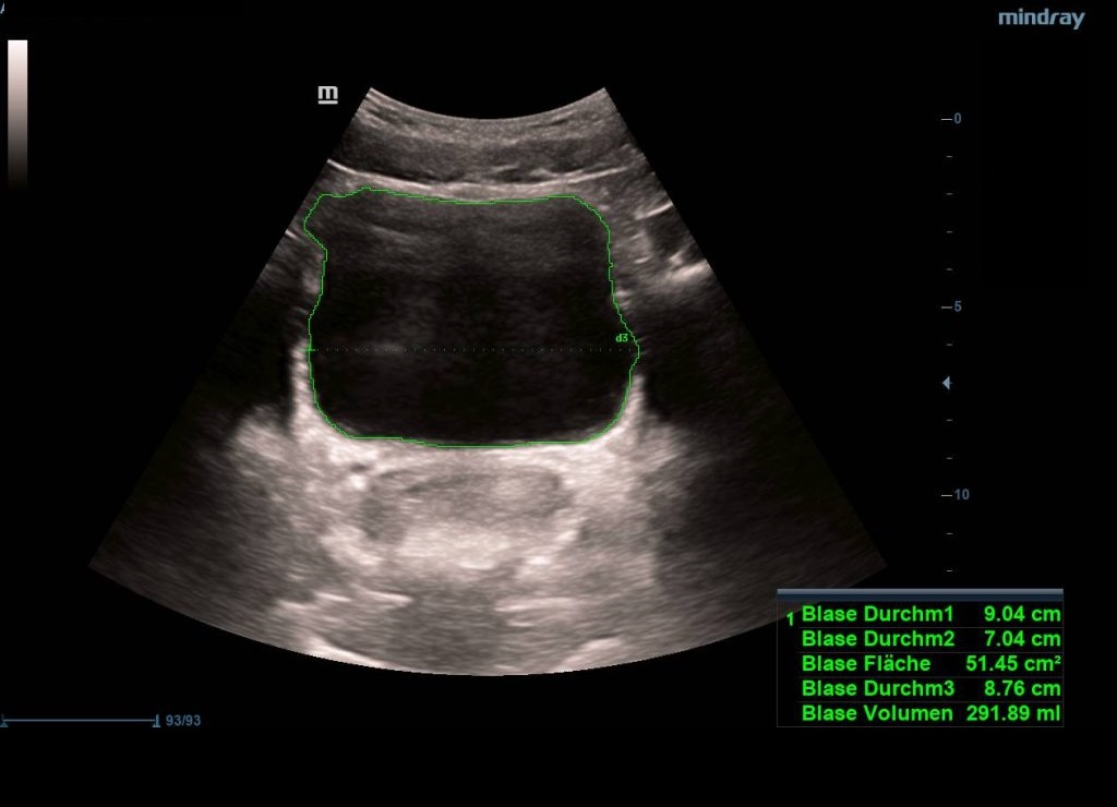 Smart Bladder (automatic calculation of Bladder Volume) - Софтуер за ехограф Mindray