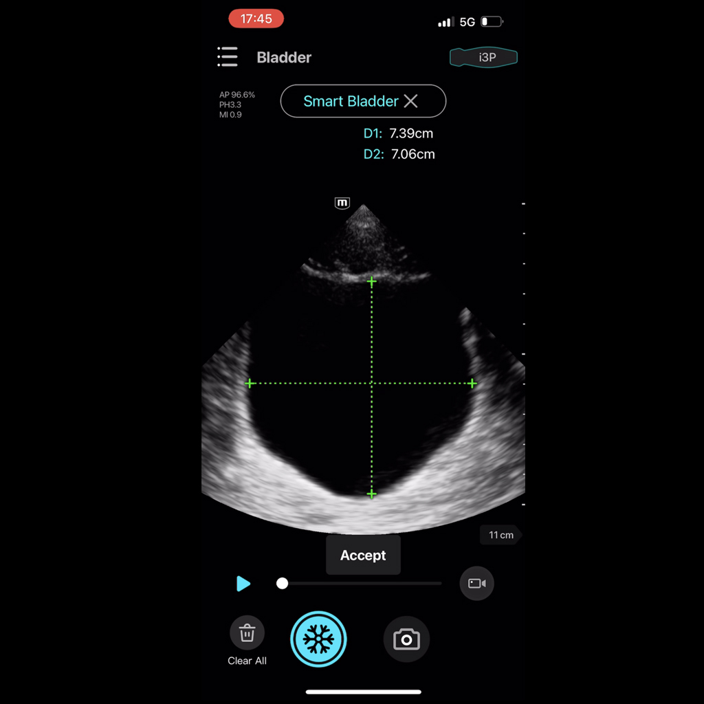 Smart Bladder (automatic calculation of Bladder Volume) - Софтуер за ехограф Mindray