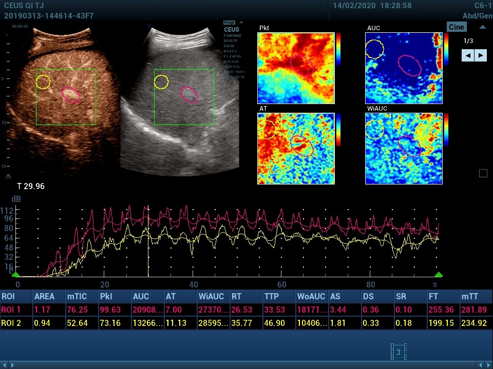 UWN+ Contrast Imaging™ QA - Софтуер за ехограф Mindray