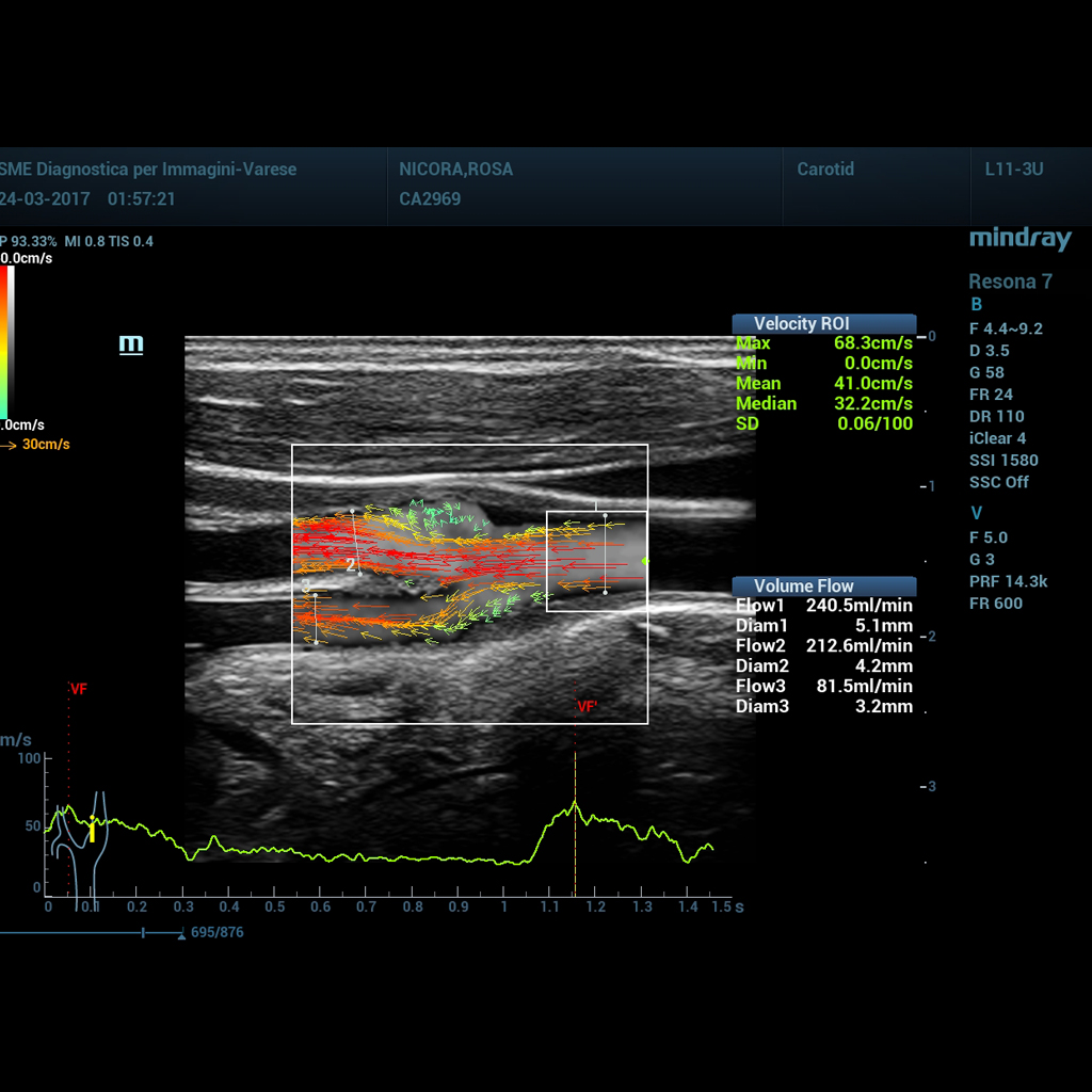 V Flow - Mindray Ultrasound Software