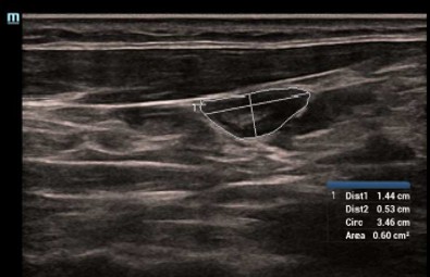 Smart Trace - Софтуер за ехограф Mindray