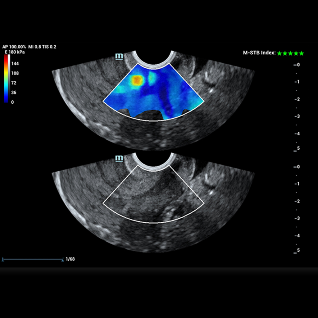 Sound Touch Elastography (STE) - Софтуер за ехограф Mindray