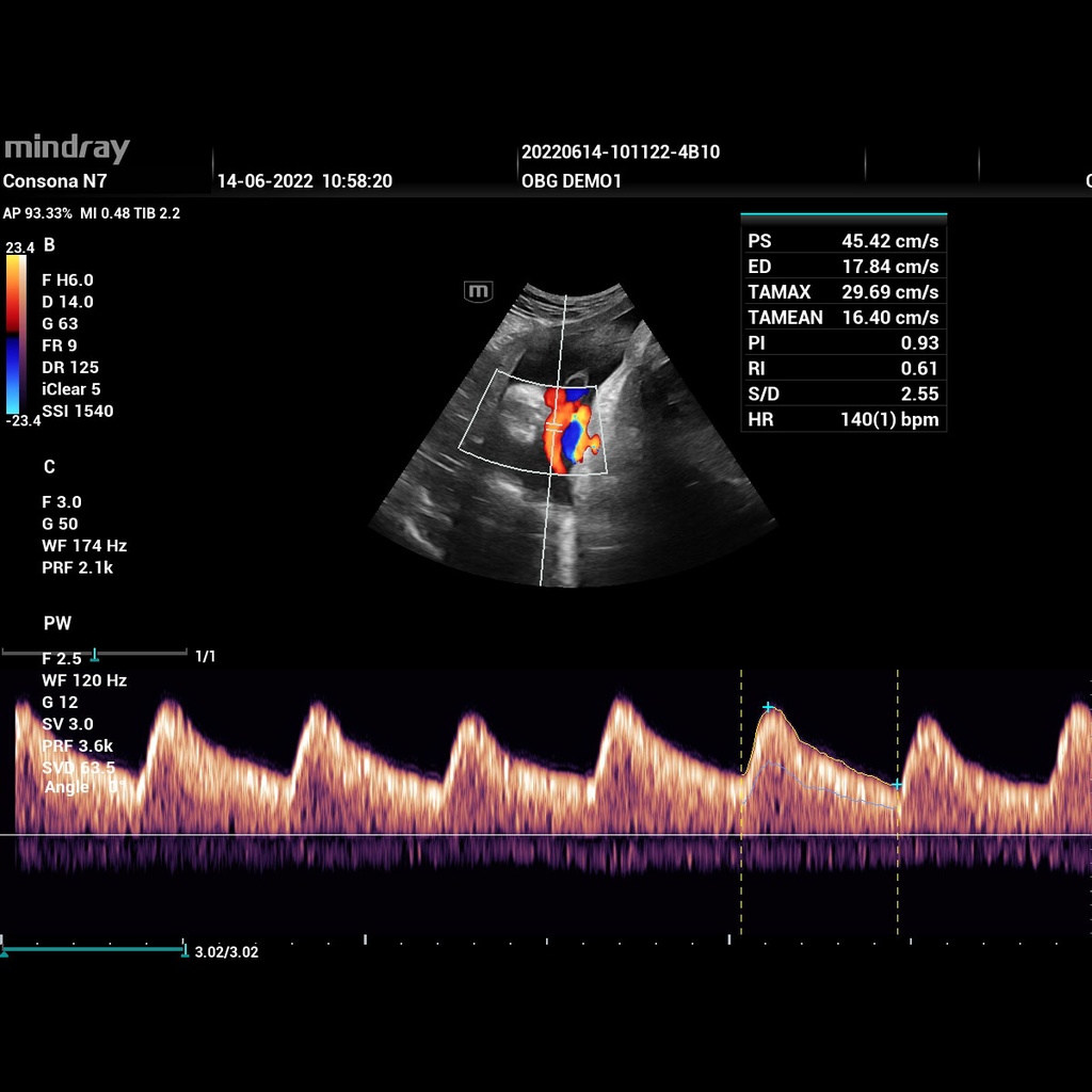 PW (Pulsed Wave) Mode and Auto Trace - Software for Mindray Ultrasound