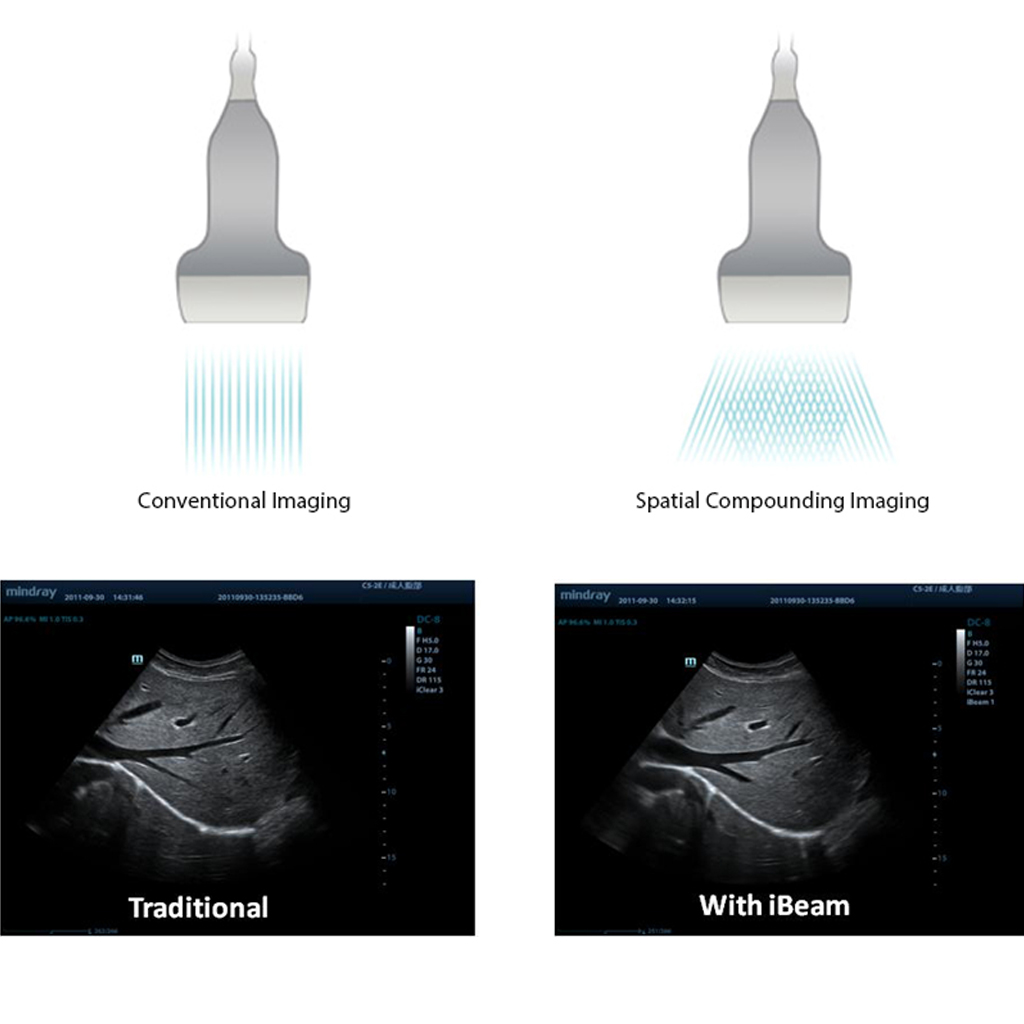 iBeam™ (Spatial Compounding Imaging)