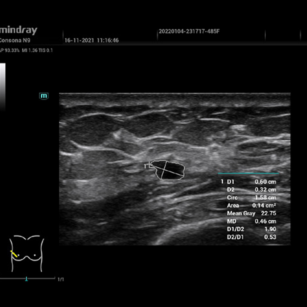 Smart Calc - Mindray Ultrasound Software