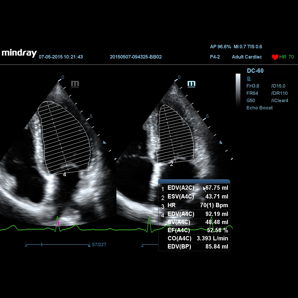 Auto EF - Mindray Veterinary Ultrasound Software