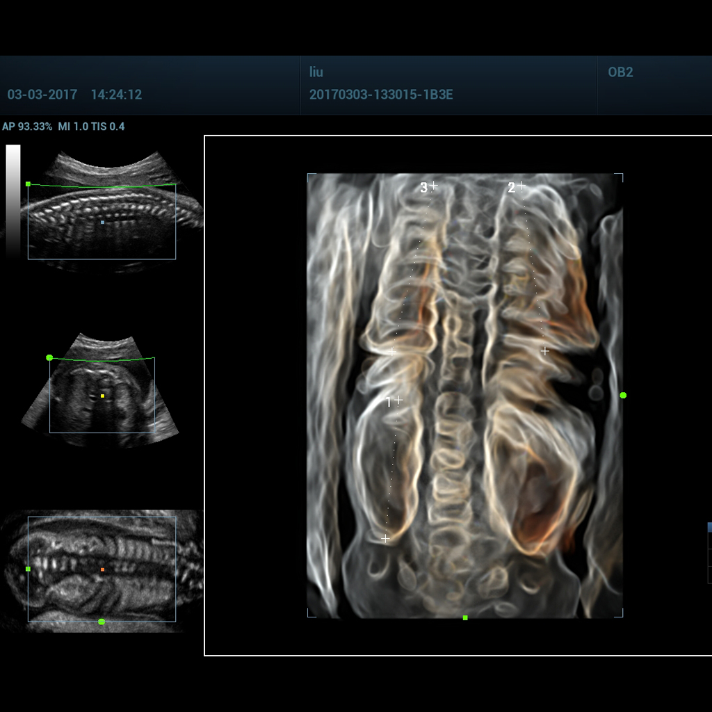 iLive™ with Hyaline - Софтуер за ехограф Mindray