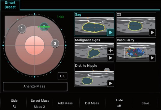 Smart Breast - Софтуер за ехограф Mindray
