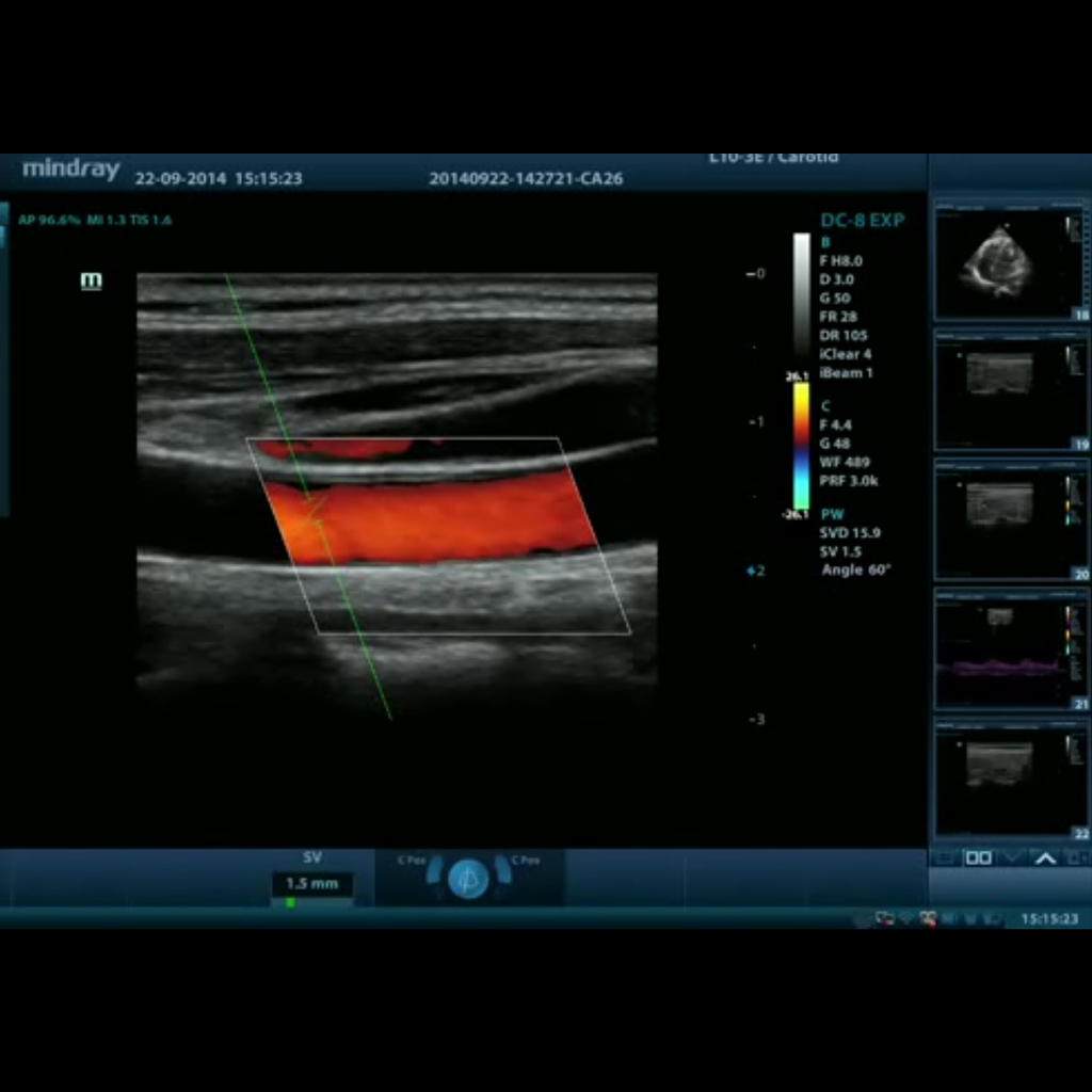 Smart Doppler (Intelligent Doppler optimization)