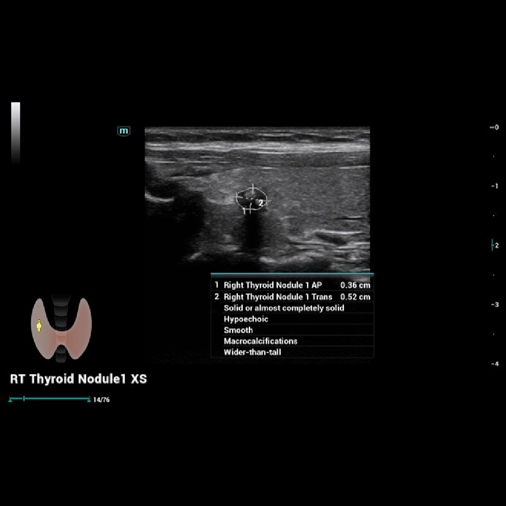 Smart Thyroid - Софтуер за ехограф Mindray