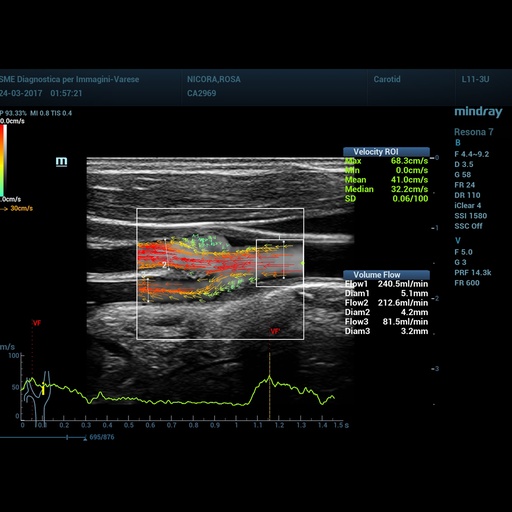 [119061721] V Flow - Mindray Ultrasound Software