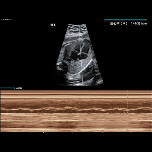 [119061734] Smart Fetal HR - Софтуер за ехограф Mindray