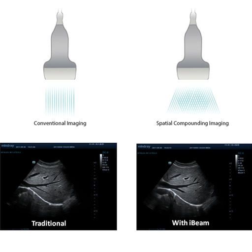 [119061829] iBeam™ (Spatial Compounding Imaging)