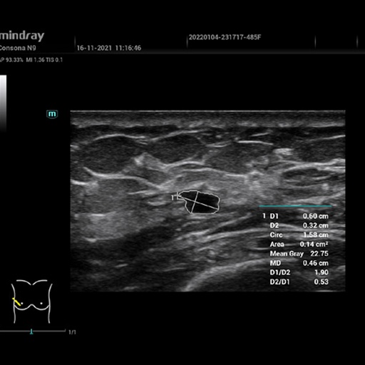 [119061837] Smart Calc - Mindray Ultrasound Software