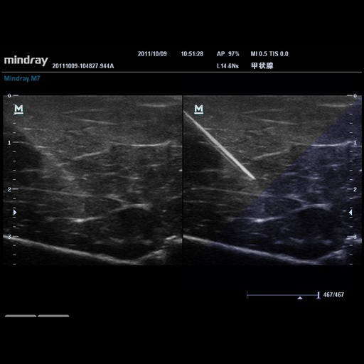 [1571500212] iNeedle™ - Mindray Ultrasound Software