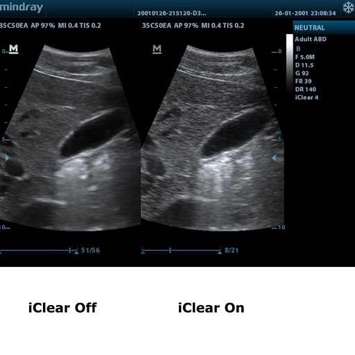 [11906672] iClear™ (Speckle Suppression Imaging)