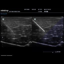 [119061667] iNeedle™ - Mindray Ultrasound Software