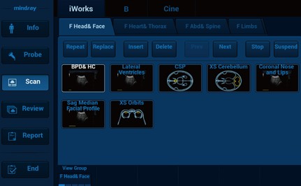 [119061682] iWorks™ (Standardized Workflow Protocol) - Софтуер за ехограф Mindray