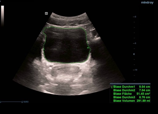 [119061697] Smart Bladder (automatic calculation of Bladder Volume) - Софтуер за ехограф Mindray